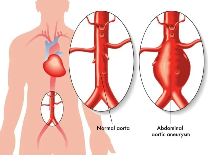 abdominal aortic aneurysm (AAA)