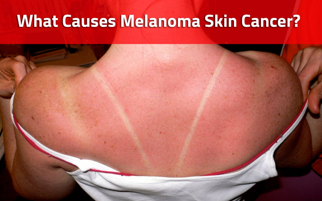 What causes melanoma cancer?