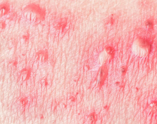 natural ways to prevent shingles